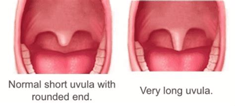 You can get a swollen uvula from infections including the flu, mononucleosis, croup, and strep throat. Even a common cold can cause your uvula to swell. Depending on the type of your infection ...