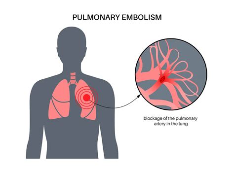 Embolism