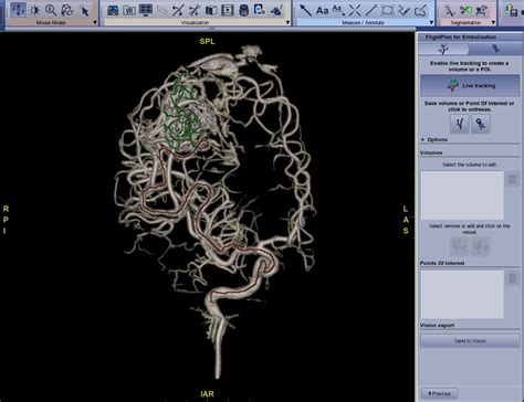 Embolization: Selected Procedures - Medical Clinical …