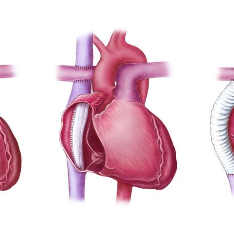 Emma Scheltema Illustration Fontan Procedure published in EMJ Cardiology