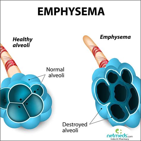 Emphysema Definition & Meaning Dictionary.com