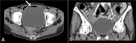 Emphysematous cystitis - Wikipedia