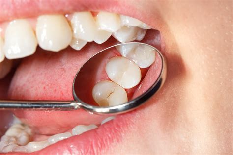 Enamel dentistry. Things To Know About Enamel dentistry. 