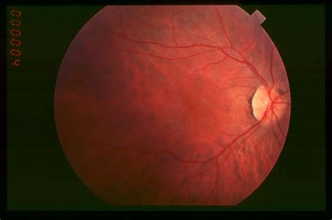 Encouraging news for treatment targeting retinitis pigmentosa