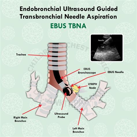 Endobronchial ultrasound guided transbronchial needle aspiration ebus tbna a practical. - Tonka: i'm a great big eighteen wheeler.