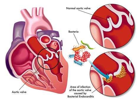 Endokarditis : definition of Endokarditis and synonyms of