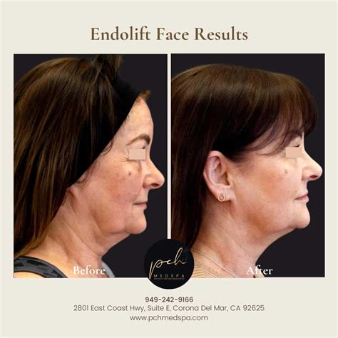 Endolift; Ameliyatsız Lazerle Yüz Germe İşlemi Instagram.