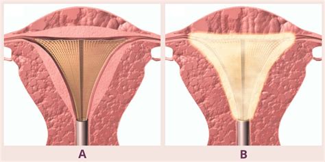 Endometrial Ablation - South Coast Urogynecology