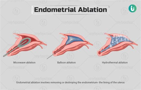 Endometrial ablation and weight loss. Things To Know About Endometrial ablation and weight loss. 