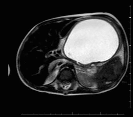 Endoscopic Cystogastrostomy of a Pancreatic Retention Cyst i ... - LWW