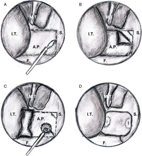 Endoscopic Repair of Choanal Atresia - ScienceDirect