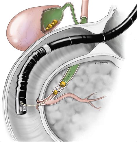 Endoscopic Retrograde Cholangiopancreatography (ERCP) - SGNA