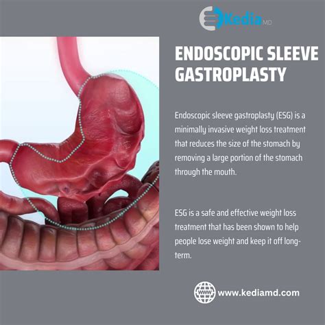 Endoscopic Sleeve Gastroplasty Price