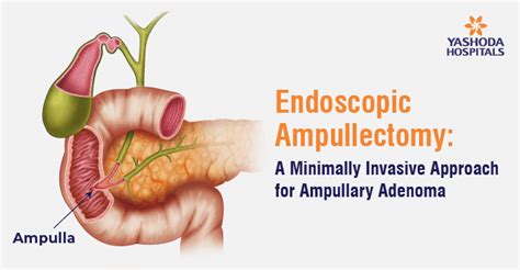 Endoscopic ampullectomy for non-invasive ampullary lesions: …