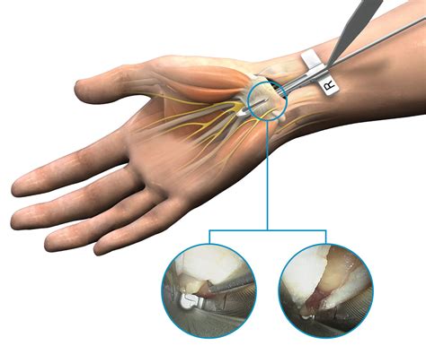 Endoscopic carpal tunnel release cpt. of the endoscopic release is less postoperative pain, earlier return of grip strength, and earlier return to work. 7) What are the results of surgery for carpal tunnel syndrome? The majority of patients undergoing carpal tunnel release note an improvement in their symptoms. Some patients may notice persistent numbness and tingling. This will occur 