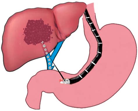 Endoscopic ultrasound-guided vascular interventions: An …