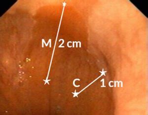 Endoscopy Campus - Prague Classification Barrett …