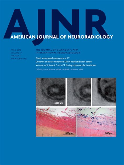 Endovascular Treatment of Unruptured Paraclinoid Aneurysms