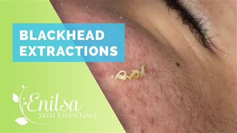By Jennifer Nied Published: Dec 10, 2020. Save Article. In Dr. Pimple Popper's new Instagram video, she helped a patient with a juicy ear blackhead. This blackhead was growing and growing behind ...