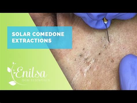 Enilsa Skin Essentials is an Acne & Anti-Aging Clinic and skincare product line created by Enilsa Brown. Our goal is to guide you through your personal journey to clear, healthy, and blemish free ... . 