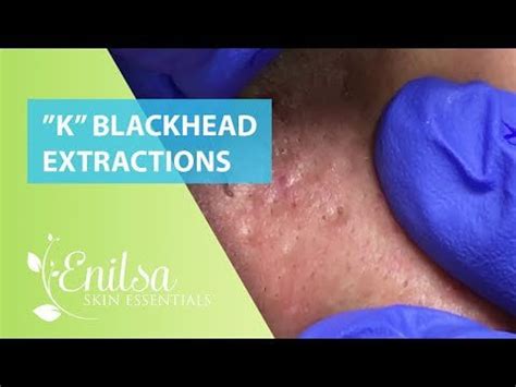 New Enilsa Brown - Blackhead and Whitehead Extraction