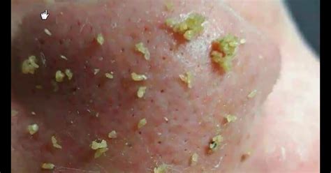 Enilsa pimple popping. Please note that if you are under 18, you won't be able to access this site. 