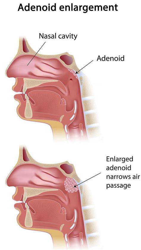 Enlarged Adenoids - Mankato - Mayo Clinic Health System