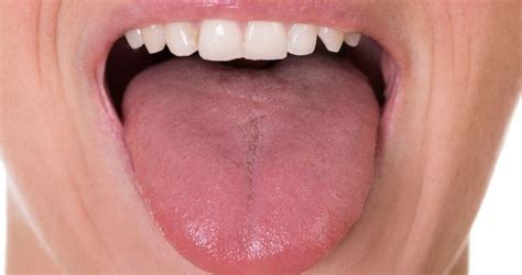 Enlarged Papillae - Pictures, Symptoms, Causes, …