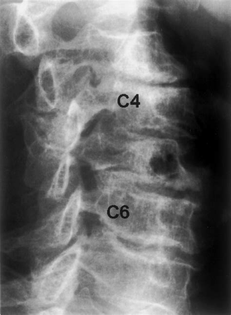 Enlarging Vertebral Body Pneumatocysts in the Cervical Spine