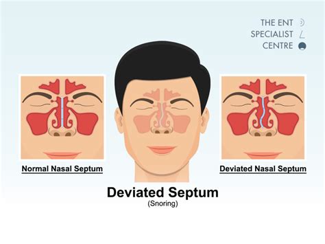 Ent ppt free download.  Nasal disorders covered include deviated septum, sinus...
