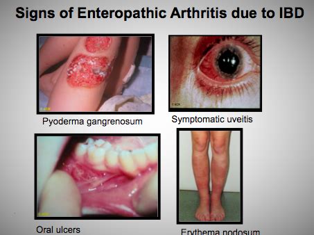 Enteropatik artrit