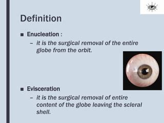 Enucleation and Evisceration What to Expect