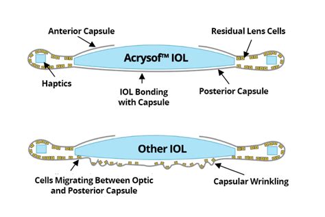 Envista iol constant.  Explore AcrySof&reg; IQ Monofocal and Toric IOLs, a trusted choice for c...