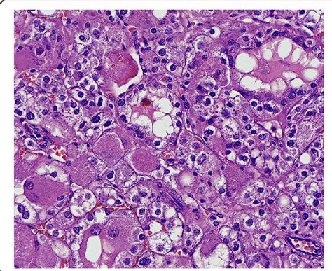 Eosinophilic Solid and Cystic Renal Cell Carcinoma With Melanin …