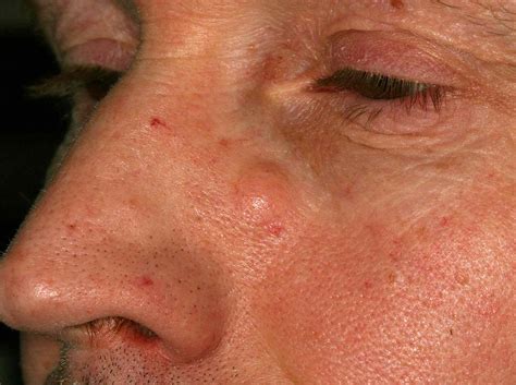 Epidermoid Cysts of the Skin