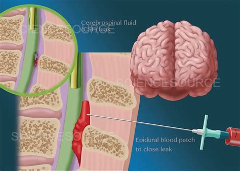 Epidural Blood Patch What is an epidural blood patch Why is it …