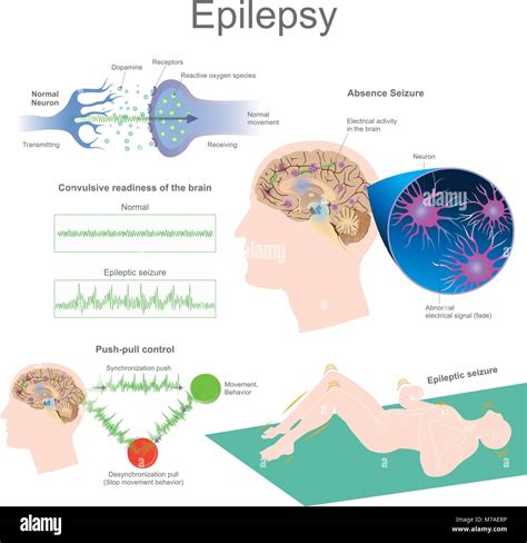 Epilepsy is a neurological disorder