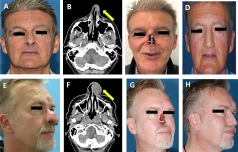 Epithetic nasal reconstruction after total rhinectomy: Oncologic ...