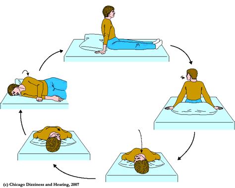 Epley maneuver at home. Things To Know About Epley maneuver at home. 