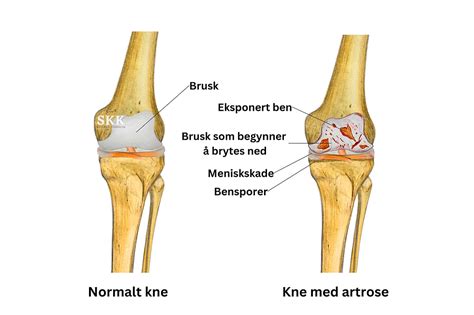 Er artrose inflammatorisk