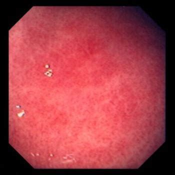 Erosive Gastritis - Gastrointestinale Erkrankungen - MSD