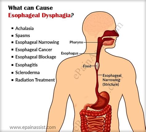 Esophageal Dysphagia - an overview ScienceDirect Topics