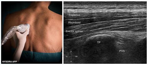 Esp ultrasound. Things To Know About Esp ultrasound. 