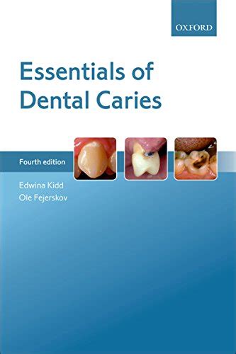 Full Download Essentials Of Dental Caries By Ole Fejerskov