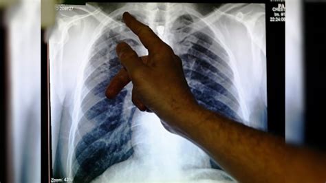 Europe’s TB deaths rise for first time in 2 decades