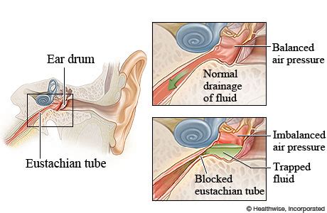 Eustachian Tube Dysfunction Mass Eye and Ear