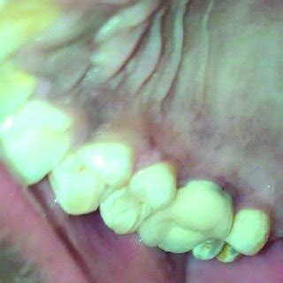 Evaluation of Healing Effect of Laser Bandage Following Gingivectomy …