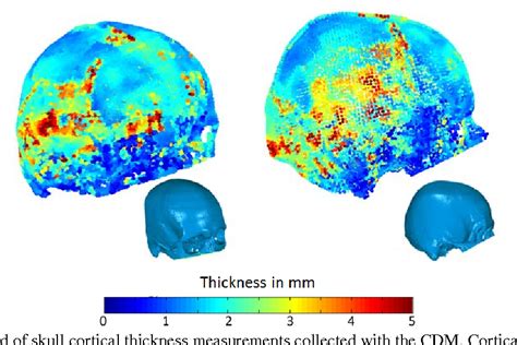 Evaluation of Skull Cortical Thickness Changes With Age and ... - PubMed