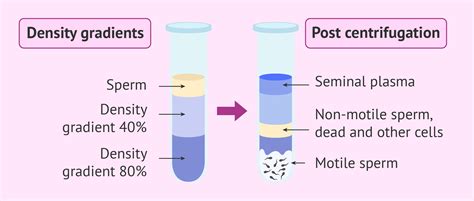 Evaluation of a new sperm density gradient and sperm …