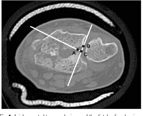 Evaluation of the sigmoid notch with computed tomography …